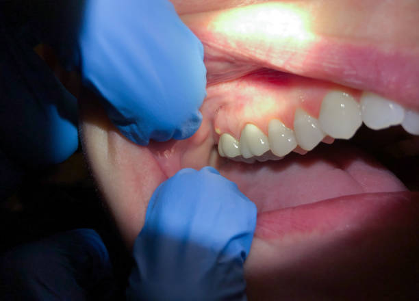 Best Emergency Dentist for Lost Fillings or Crowns in Lockwood, MO